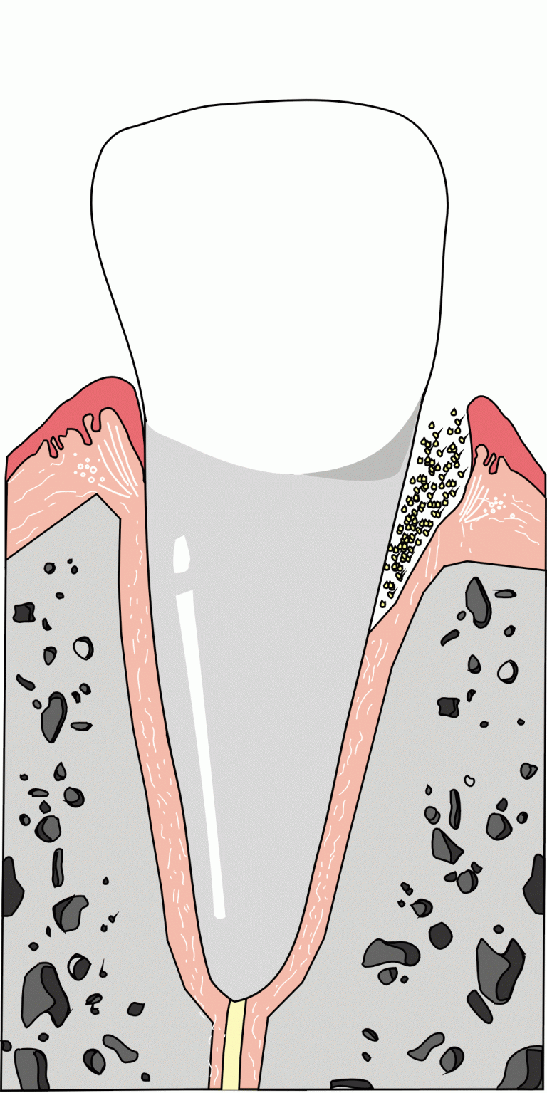ParodontoseTherapie (PA) Zahnarztpraxis Dr. Wilharm